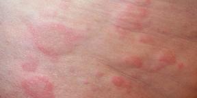Alergije u djece: Sve što roditelji trebaju znati o dijagnostici i liječenju