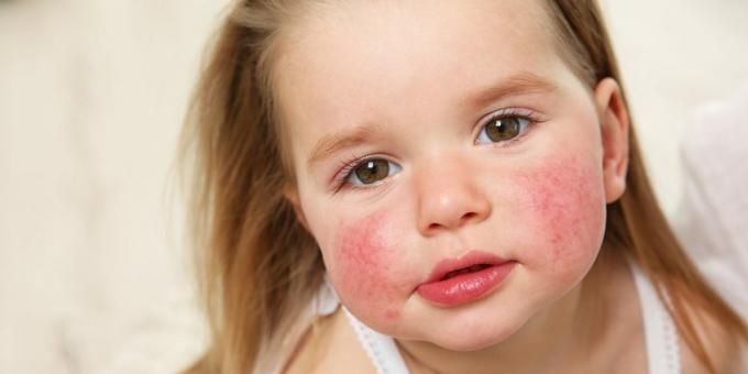 Osip na licu: alergija na hranu