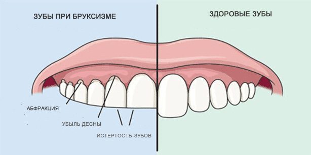 Zubi brušenje: Zdrave zube i zube tijekom bruksizmom