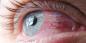 Konjunktivitis: zašto ocrveniti oči i kako ih liječiti
