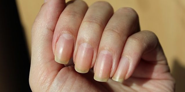 Žuti nokti zbog crvene ili narančaste lak za nokte