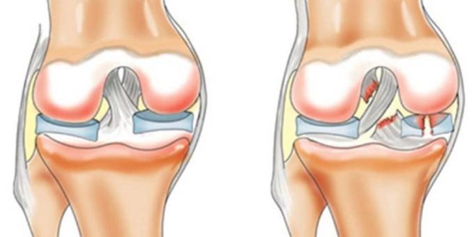 Zašto ozlijediti koljena: prednji križni ligament rupture