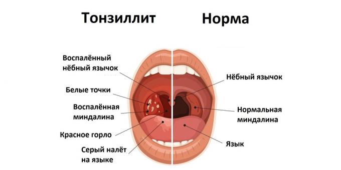 Tonsilitis i normalno stanje 