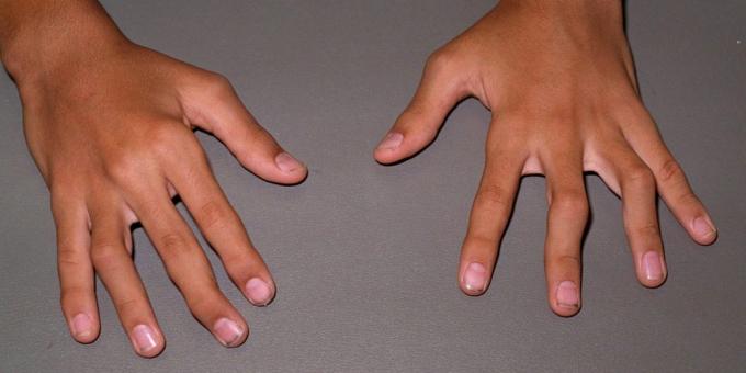 U kasnim fazama reumatoidnog artritisa su moguće deformacije i savijanje zglobova
