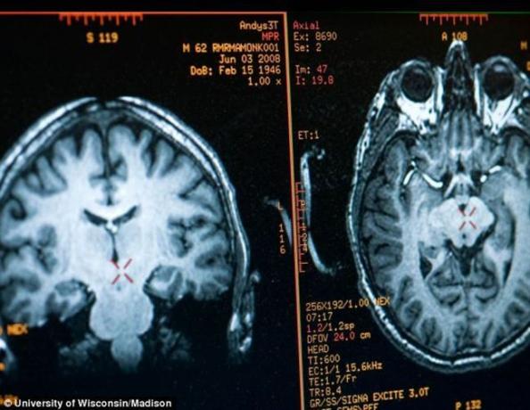 Mozak Mathieu Ricard slike dobivene magnetskom rezonancijom