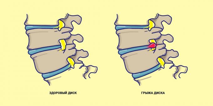 Kila kralježnice u usporedbi sa zdravim leđima