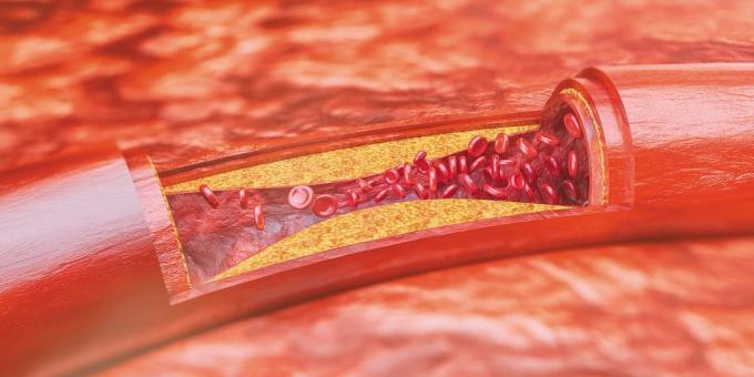 Kolesterol: aterosklerotične plakove