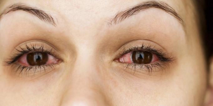 Zašto svrbež očiju, konjuktivitis
