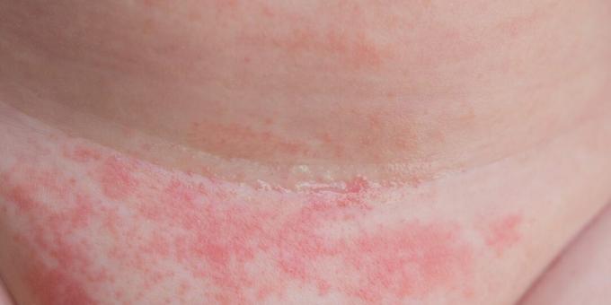 Dermatomikoza: kožna kandidijaza