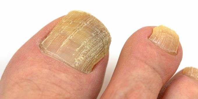 Dermatomikoza: gljiva na noktima