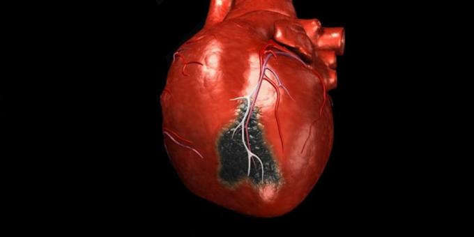 Simptomi srčanog udara, za koje treba pozvati hitnu pomoć