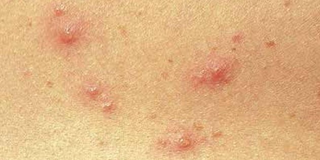 Simptomi boginja u djece i odraslih: Vrlo često se koža odmah pojaviti male crvene točkice