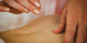 Akupunktura: Što je vrijedno znati o liječenju tanke igle