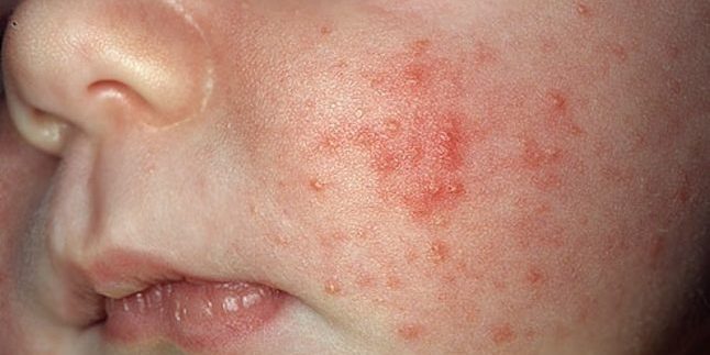 Kako da biste dobili osloboditi od acne: Akne novorođenče