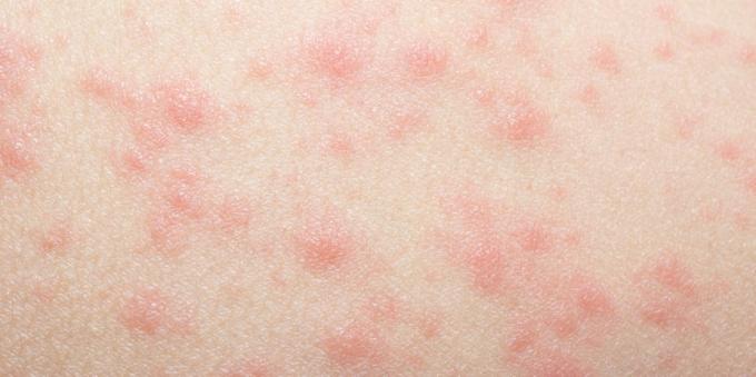 Osip na koži s alergijama na lijekove